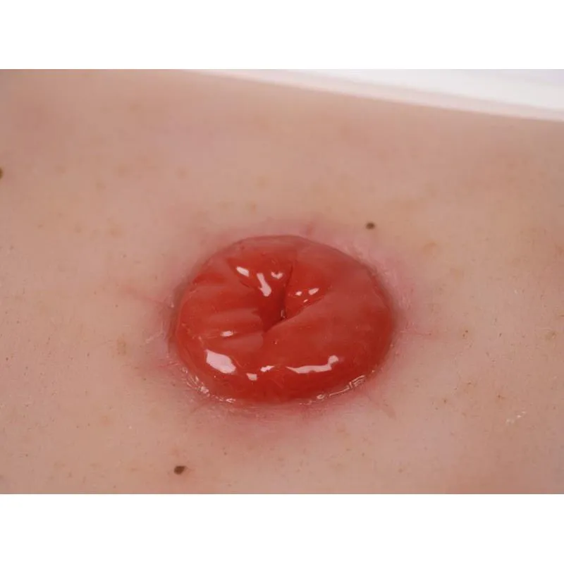 Wound Moulage Colostoma, incl. Stand